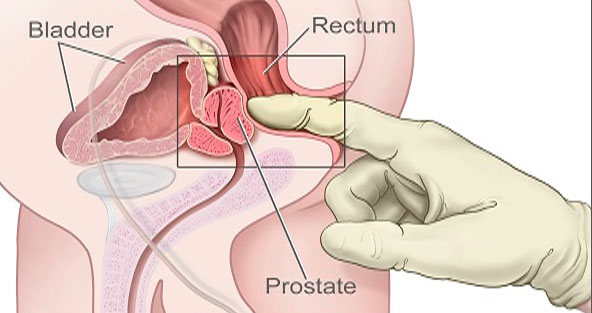 exame-de-prostata